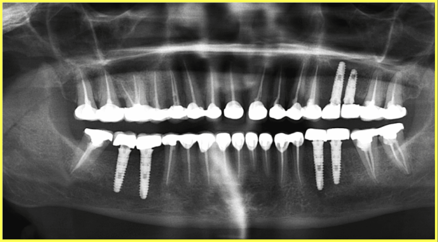 Full Mouth Rehabilitation of Multiple Missing and Worn Teeth - Gallery 3