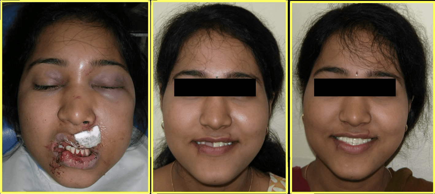 Cosmetic Restoration After Road Traffic Accident - Gallery 5