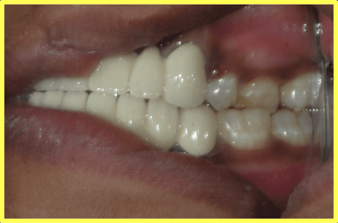 Cosmetic Restoration After Road Traffic Accident - Gallery 2