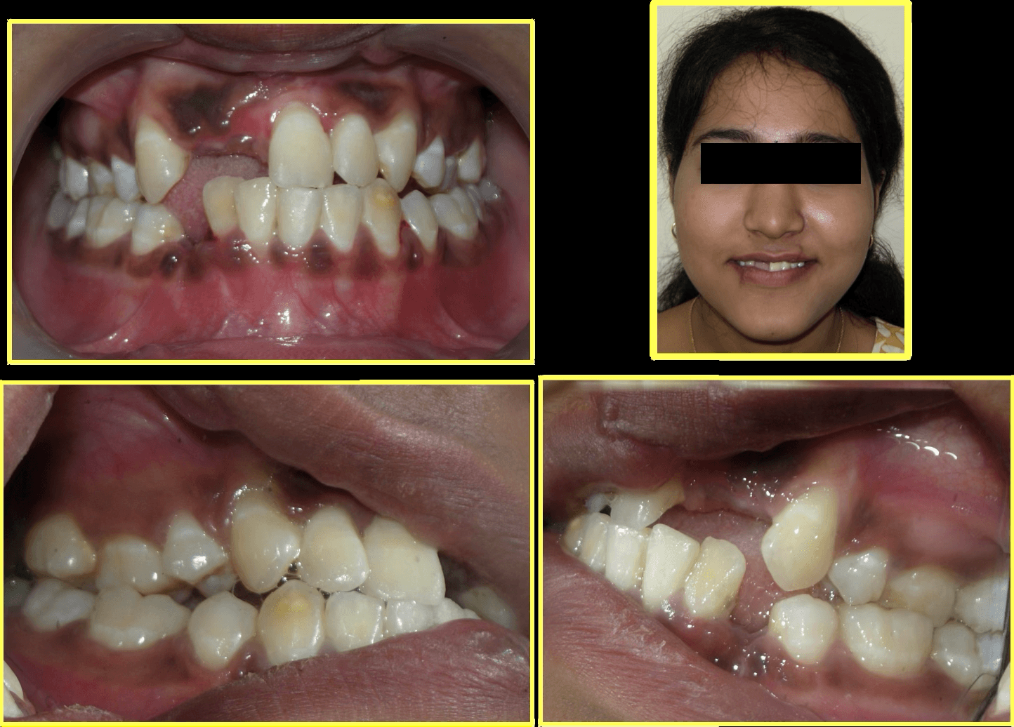 Cosmetic Restoration After Road Traffic Accident - Gallery 3
