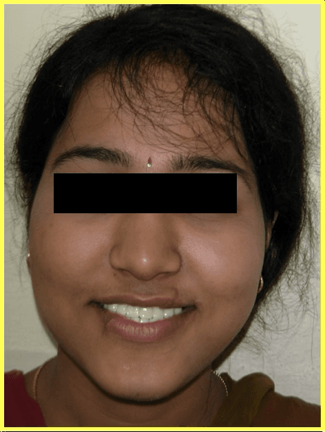 Cosmetic Restoration After Road Traffic Accident - Gallery 4