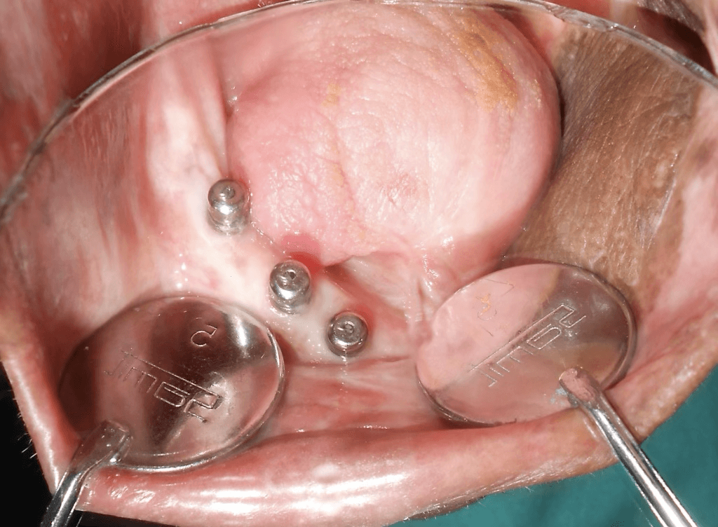 Full Mouth Rehabilitation of Oral Cancer Survivor Patient - Gallery 2