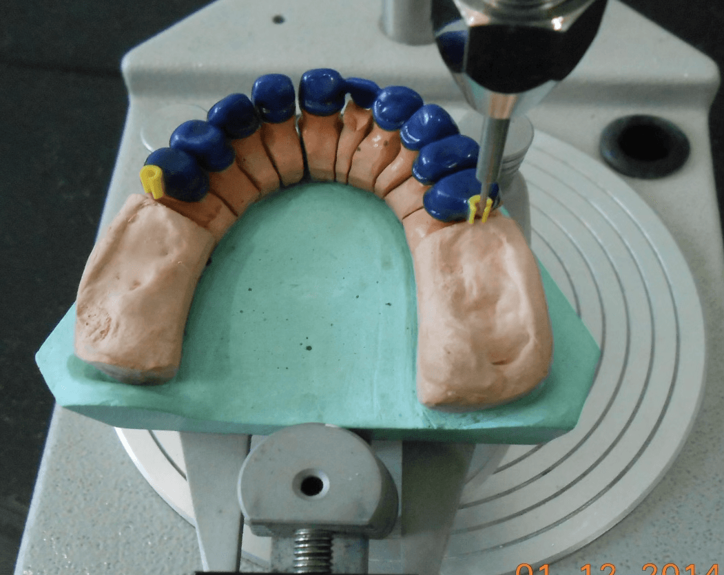 Full Mouth Rehabilitation of Oral Cancer Survivor Patient - Gallery 3