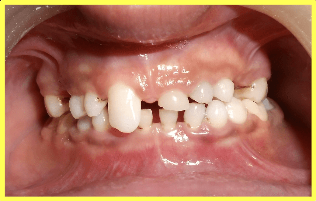 Oligodontia Treatment with Telescopic Prosthesis - Gallery 1