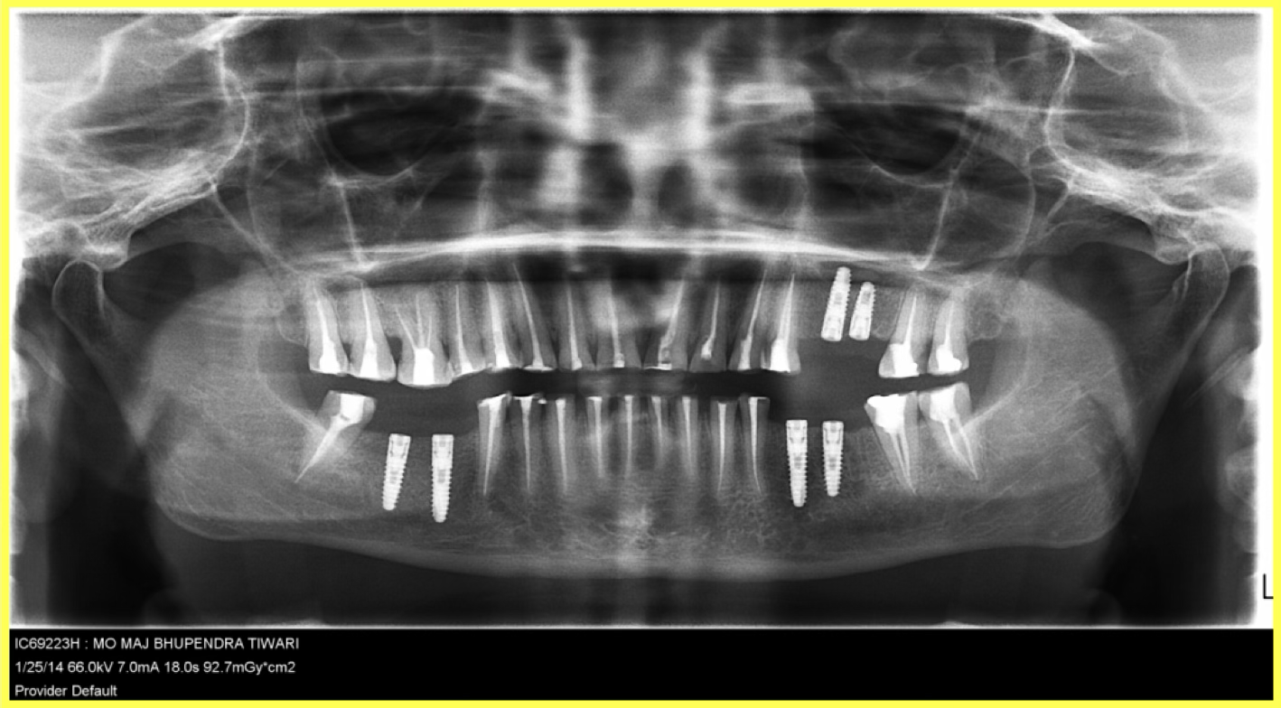 Implant Placement