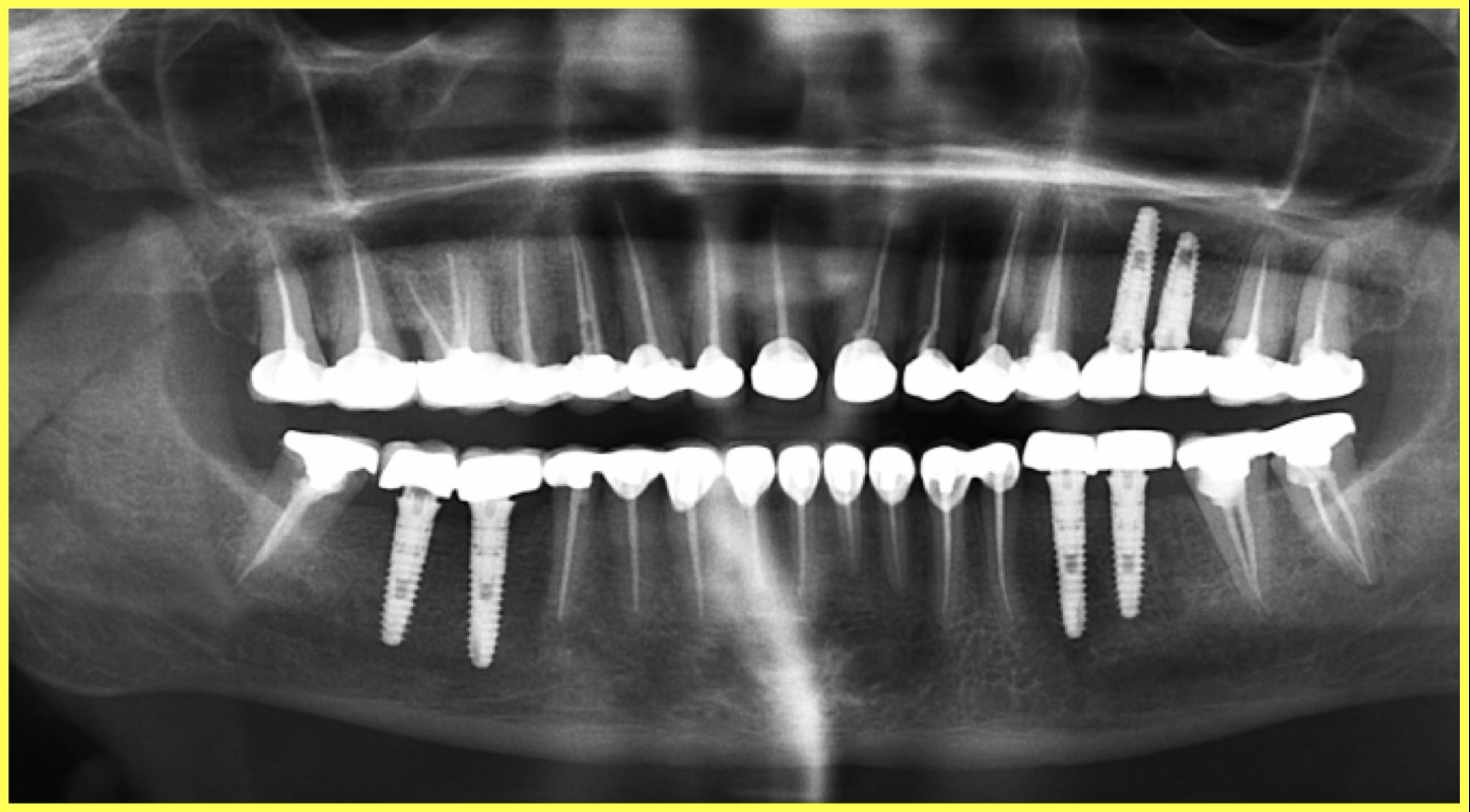 Endodontic Treatment