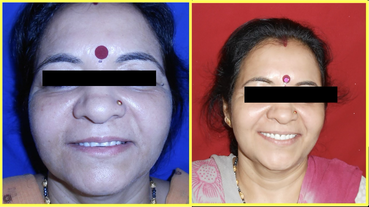 Full Mouth Rehabilitation of Multiple Missing and Worn Teeth