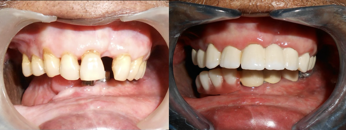 Full Mouth Rehabilitation of Oral Cancer Survivor Patient