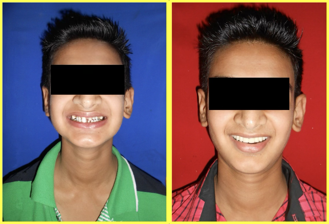 Oligodontia Treatment with Telescopic Prosthesis