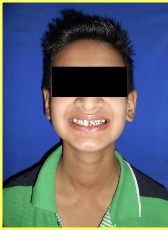 Oligodontia Treatment with Telescopic Prosthesis