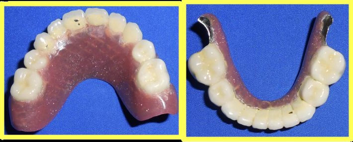 Telescopic Prosthesis Delivery