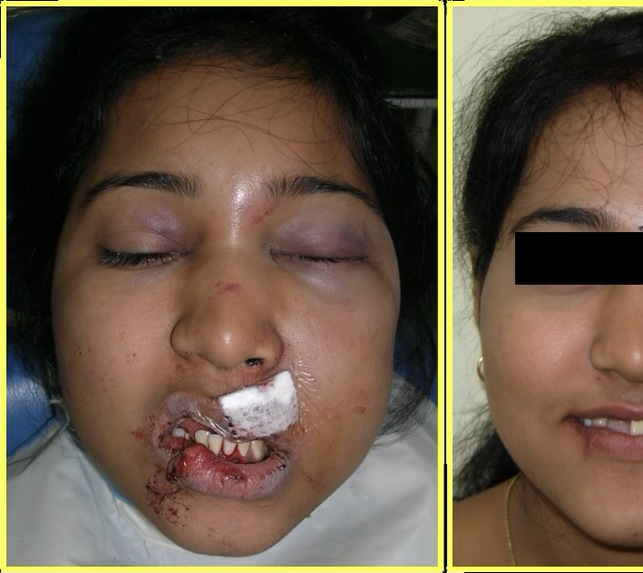 Cosmetic Restoration After Road Traffic Accident